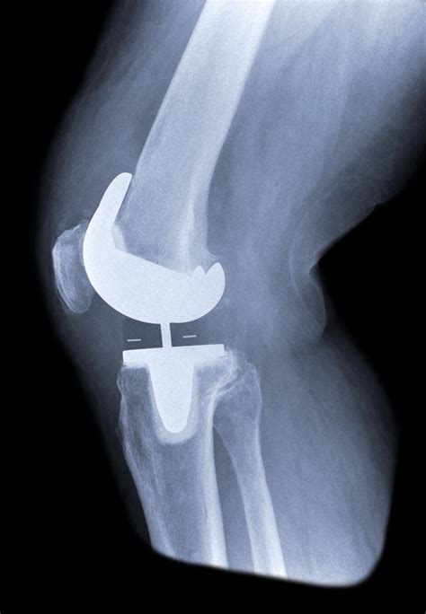 I think I twisted my knee... - Joint Replacement Patient Forum