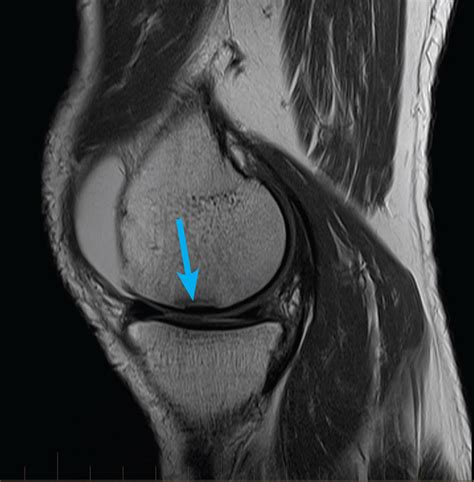 ICD-10 Code for Tear of articular cartilage of unspecified knee