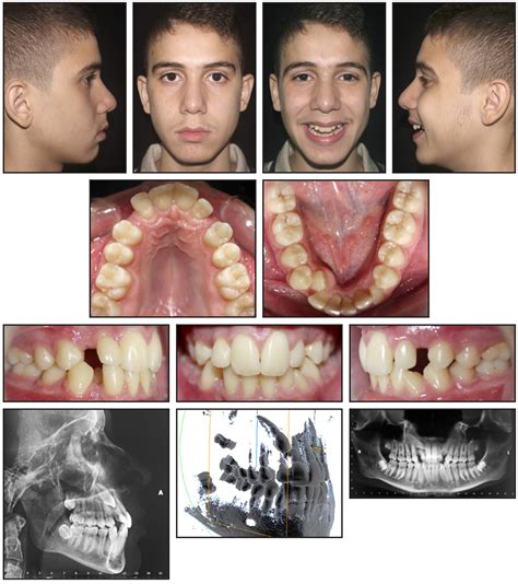 IMPACTED CANINE EXTRACTION COMPLICATION: CASE.