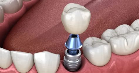 Implan gigi dalam peradaban kuno - wintechmobiles.com