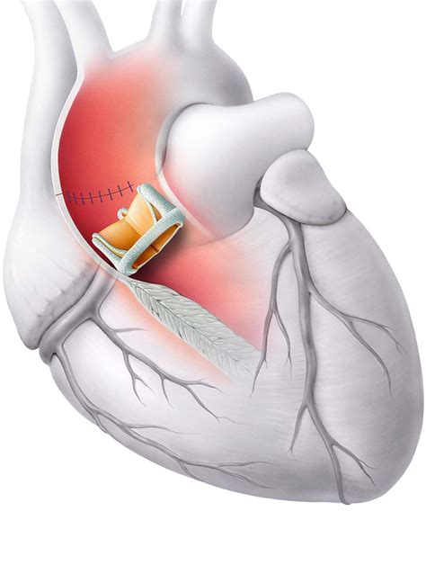 IMPLANTS CARDIAQUES PAR TECHNIQUE CHIRURGICALE ET …