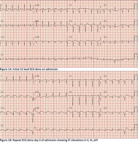 INFERIOR ST SEGMENT ELEVATION IN GASTROINTESTINAL …