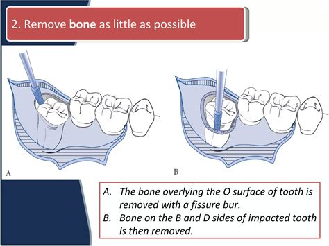 Instrumen Pencabutan dan Odontectomy | PDF - Scribd - wintechmobiles.com