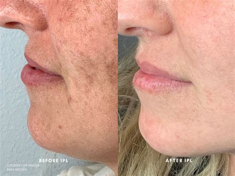 Smooth Skin Results