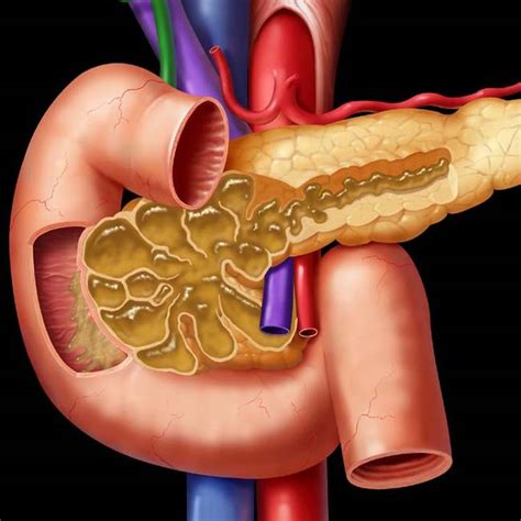 IPMN PANCREAS - Pancreatic neuroendocrine tumors