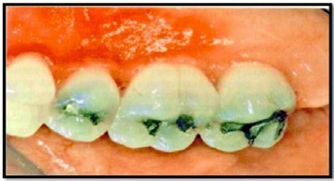 Iatrogenic Damage to the Periodontium Caused by Exodontic …