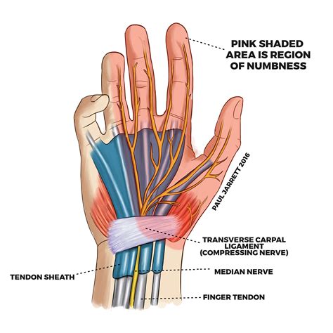 Carpal tunnel syndrome is a nervous system disease that occurs due to compression of the median nerve. Therefore, the correct ICD-10-CM code for Mary’s doctor visit is G56.03 Carpal tunnel syndrome, bilateral upper limbs. The code, G56.03, follows ICD-10-CM guidelines because I coded what was documented in the available outpatient record and ...