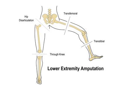 Below-knee amputation—transtibial amputation . Above-kne