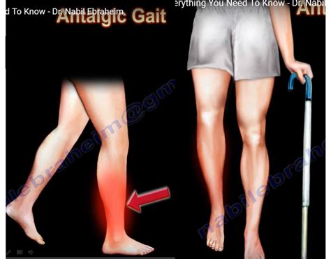 Icd 10 code for antalgic gait. Things To Know About Icd 10 code for antalgic gait. 