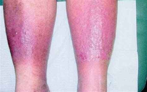 Cellulitis in chronic leg oedema is a global problem. Several risk factors for cellulitis were identified, of which some are potentially preventable. ... Adults with clinically proven unilateral or bilateral chronic oedema (oedema > 3 months) of the lower leg were included. The main outcome measures were frequency and risk factors for .... 