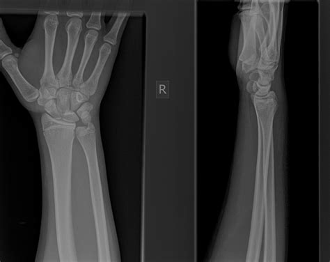 Icd 10 code for fracture wrist. The 2024 edition of ICD-10-CM S52.61 became effective on October 1, 2023. This is the American ICD-10-CM version of S52.61 - other international versions of ICD-10 S52.61 may differ. Use secondary code (s) from Chapter 20, External causes of morbidity, to indicate cause of injury. 