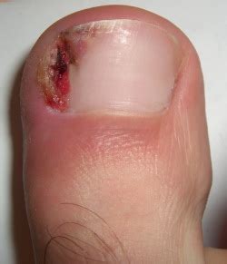 ICD-10-CM Diagnosis Code L03.0. ... Nail problems that sometimes require treatment include bacterial and fungal infections, ingrown nails, tumors and warts. Keeping nails clean, dry and trimmed can help you avoid some problems. Do not remove the cuticle, which can cause infection.. 