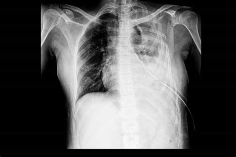 500 results found. Showing 1-25: ICD-10-CM Diagnosis Code S29.9XXA [convert to ICD-9-CM] Unspecified injury of thorax, initial encounter. Chest injury; Chest wall injury; Injury of chest wall; Injury of ribs; Left breast injury; Posterior thorax injury; Rib injury; Right breast injury.. 