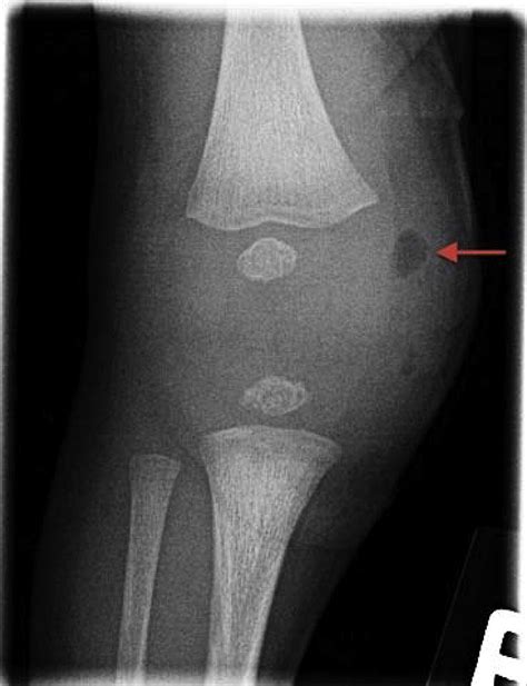 Acute osteomyelitis of right foot ICD-10-CM M86.171 is grouped within Diagnostic Related Group (s) (MS-DRG v41.0): 539 Osteomyelitis with mcc 540 Osteomyelitis with cc 541 Osteomyelitis without cc/mcc Convert M86.171 to ICD-9-CM Code History 2016 (effective 10/1/2015): New code (first year of non-draft ICD-10-CM) . 