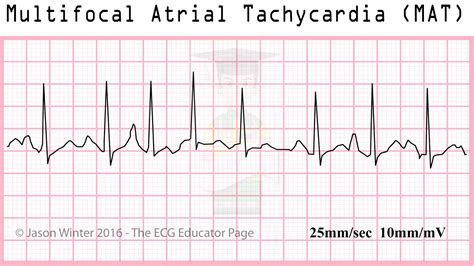 Icd 10 for atrial tachycardia. Introduction. Atrial arrhythmias are common in patients with congenital heart disease (CHD) and are a leading source of morbidity and mortality. 1-3 The reported prevalence of atrial fibrillation (AF) in patients with CHD ranges from 10% to 30% and has been described primarily for adults with simple to moderate CHD. 1, 4-10 Ageing of the … 
