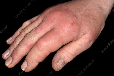 Icd 10 for cellulitis of right hand. L03.114 is a billable/specific ICD-10-CM code that can be used to indicate a diagnosis for reimbursement purposes. The 2024 edition of ICD-10-CM L03.114 became effective on October 1, 2023. This is the American ICD-10-CM version of L03.114 - other international versions of ICD-10 L03.114 may differ. 