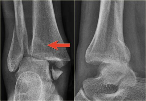 Icd 10 fracture right ankle. Z96.661 is a billable/specific ICD-10-CM code that can be used to indicate a diagnosis for reimbursement purposes. The 2024 edition of ICD-10-CM Z96.661 became effective on October 1, 2023. This is the American ICD-10-CM version of Z96.661 - other international versions of ICD-10 Z96.661 may differ. Z codes represent reasons for encounters. A ... 