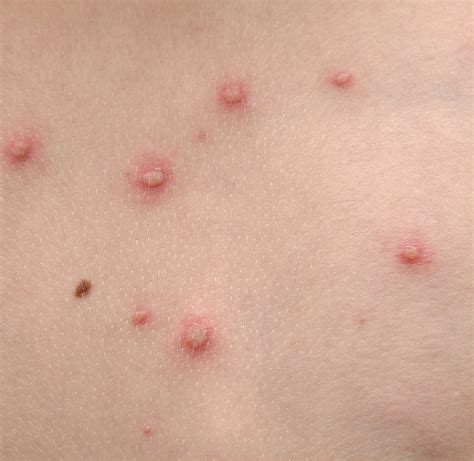 Candidiasis is skin and mucous membrane infection with Candida species, most commonly Candida albicans. Infections can occur anywhere and are most common in skinfolds, digital web spaces, genitals, cuticles, and oral mucosa. Symptoms and signs vary by site. Diagnosis is by clinical appearance and/or potassium hydroxide wet mount of skin .... 