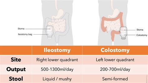 Mar 11, 2022 · Patients need to be provided with 24-hour ileostomy