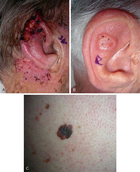 Basal-cell carcinoma (BCC), also known as basal-cell cancer, is the most common type of skin cancer. It often appears as a painless raised area of skin, which may be shiny with small blood vessels running over it. It may also present as a raised area with ulceration. Basal-cell cancer grows slowly and can damage the tissue around it, but it is unlikely to spread to distant areas or result in .... 