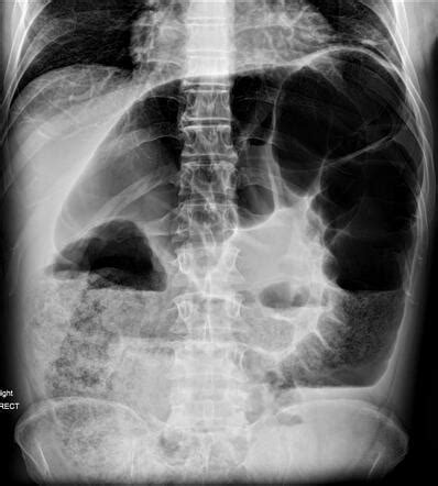 In large-bowel obstruction, abdominal x-ray shows dis