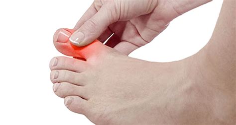 Icd 10 left toe pain. Primary osteoarthritis, left ankle and foot. M19.072 is a billable/specific ICD-10-CM code that can be used to indicate a diagnosis for reimbursement purposes. The 2024 edition of ICD-10-CM M19.072 became effective on October 1, 2023. 