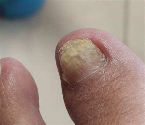 References in the ICD-10-CM Index to Diseases and Injuries applicable to the clinical term "onychomycosis (finger) (toe)" Onychomycosis (finger) (toe) - B35.1 Tinea unguium. . 