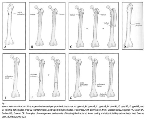  Basic Anatomy. Fractures or breaks of the bone above or around a total knee replacement (artificial joints or prostheses) are becoming more common over time. These are called peri- (around) prosthetic fractures. These mostly involve the distal femur or thigh bone. They can also involve the top of the tibia; but this is less common. . 
