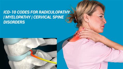 Icd 10 radiculopathy. ICD-10 Basics Check out these videos to learn more about ICD-10. ICD-10 Games Learn codes with classic games like Flashcards and Hangman. About the ICD-10 Code Lookup. This free tool is designed to help billers and coders navigate the new ICD-10-CM code set. We hope you find it helpful, and thanks for stopping by! 