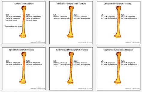 Icd 10 right femur fx. Things To Know About Icd 10 right femur fx. 