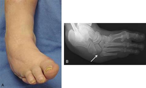 Bunion of left foot. M21.612 is a billable/specific ICD-