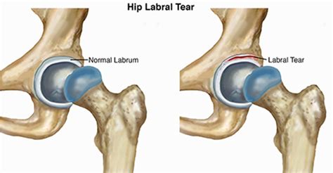 Always confused about the ICD 10 code for a labral t