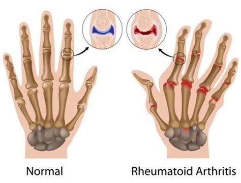Icd 10 right thumb pain. M79.641 is a billable diagnosis code used to specify a medical diagnosis of pain in right hand. The code is valid during the current fiscal year for the submission of HIPAA-covered transactions from October 01, 2023 through September 30, 2024. 