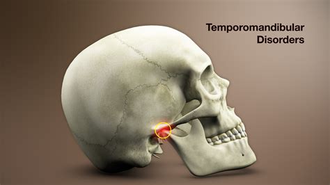 Temporomandibular disorders (TMD) are characterized by craniofacial pain involving the joint, masticatory muscles, or muscle innervations of the head and neck. 1 TMD is a major cause of nondental .... 