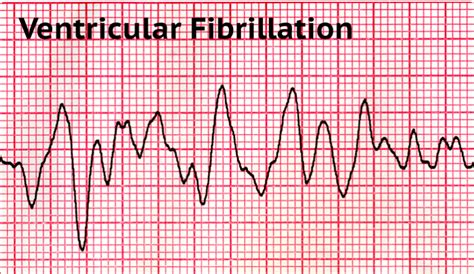 Icd 10 ventricular fibrillation. Idiopathic ventricular fibrillation (IVF) is a rare cause of SCA. Patients with IVF present with a sudden onset of ventricular fibrillation (VF) of unknown origin that is not identified even after extensive diagnostic testing. ... 14% (2/14) of patients with a secondary prophylactic ICD received appropriate ICD therapy (FU 3.2 y) 23: DCM ... 