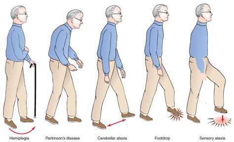 Icd unsteady gait. Things To Know About Icd unsteady gait. 