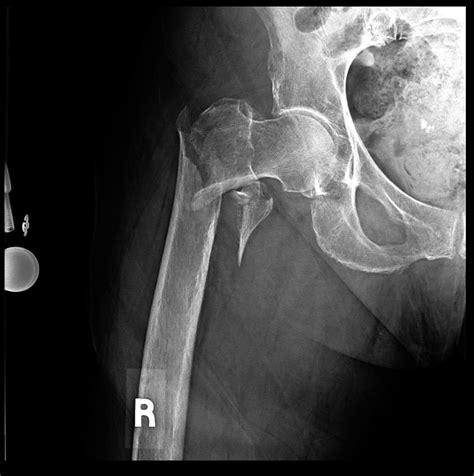 Pathological fracture of left femur; ICD-10-CM M84.452A is grouped within Diagnostic Related Group(s) (MS-DRG v 41.0): 521 Hip replacement with principal diagnosis of hip fracture with mcc; 522 Hip replacement with principal diagnosis of hip fracture without mcc; 542 Pathological fractures and musculoskeletal and connective tissue malignancy .... 