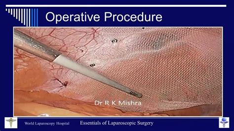 Icd-10-pcs code for laparoscopic ventral hernia repair with parietex mesh. K43.6 is a billable/specific ICD-10-CM code that can be used to indicate a diagnosis for reimbursement purposes. Short description: Other and unsp ventral hernia with obstruction, w/o gangrene The 2024 edition of ICD-10-CM K43.6 became effective on October 1, 2023. 