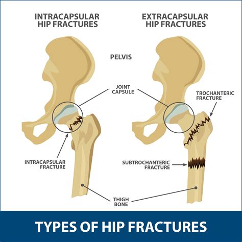 Icd10 right hip fracture. Things To Know About Icd10 right hip fracture. 