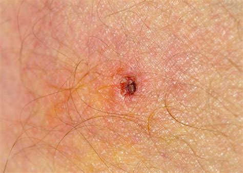 Icd10 tick bite. Things To Know About Icd10 tick bite. 