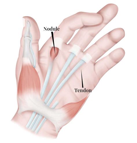 The ICD code M653 is used to code Stenosing tenosynovitis. Stenosing tenosynovitis (also known as trigger finger or trigger thumb) is a painful condition caused by the inflammation (tenosynovitis) and progressive restriction of the superficial and deep flexors fibrous tendon sheath adjacent to the A1 pulley at a metacarpal head.. 