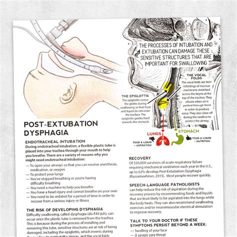 Identifying PostExtubation Dysphagia...Post Extubation Dysphagia
