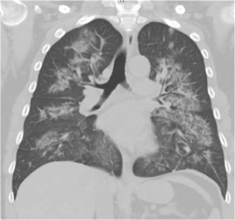 Idiopathic Pulmonary Hemosiderosis - World Health Organization