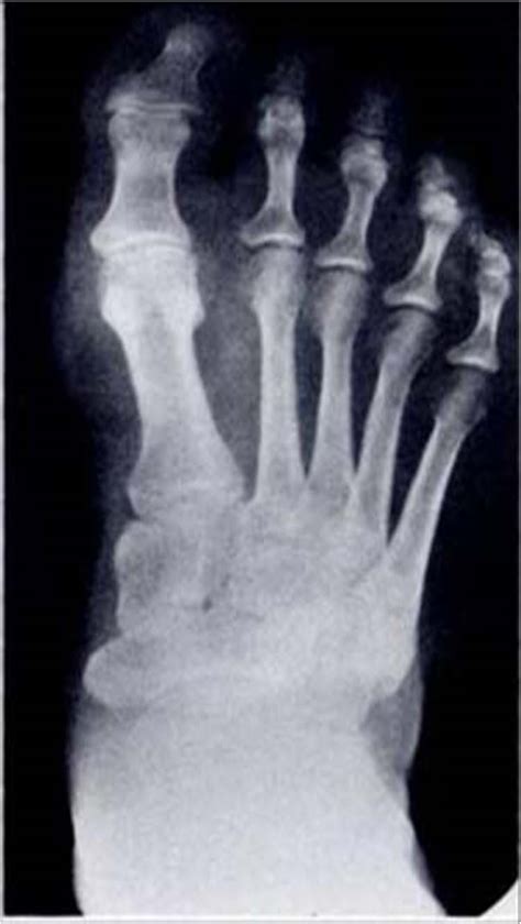 Idiopathic Transient Osteoporosis of the Feet: A case report