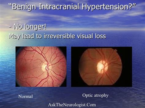 Idiopathic intracranial hypertension (pseudotumor cerebri