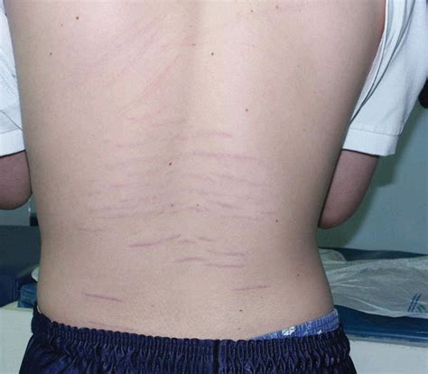 Idiopathic striae atrophicae of puberty CMAJ