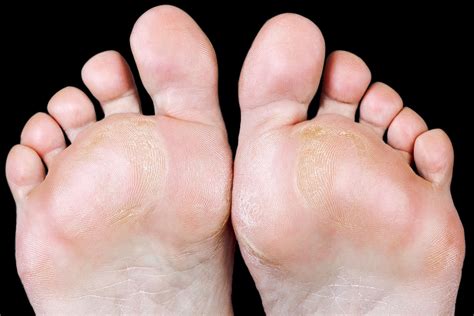 If corns and calluses are... - Sol Foot & Ankle Centers - Facebook