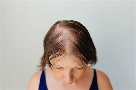 Read Online If Your Hair Falls Out Keep Dancing How To Cope With Alopecia Areata In A Hairobsessed World By Leslieann Butler