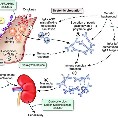 IgA nephropathy - kidneypathology.com