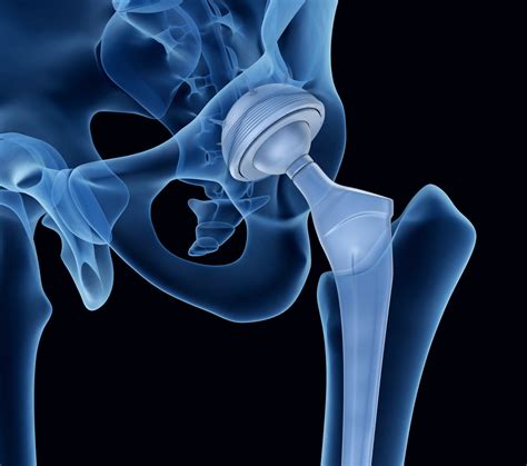 Ihr leitfaden zur totalen hüftprothese your guide to total hip replacement. - Alfa romeo spider 916 user manual.